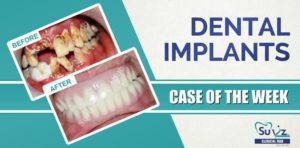 Read more about the article Full mouth rehabilitation using dental implants