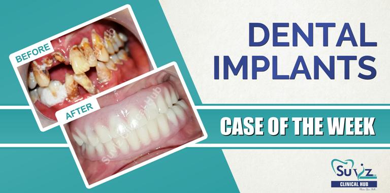 Read more about the article Full mouth rehabilitation using dental implants