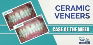 Read more about the article Maxillary Anterior Veneers