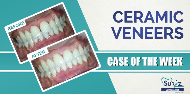 Read more about the article Maxillary Anterior Veneers