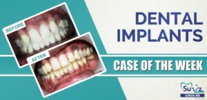 Read more about the article Esthetic correction by tooth contouring and implants.