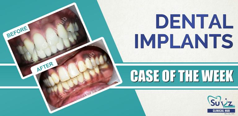 Read more about the article Esthetic correction by tooth contouring and implants.