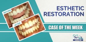 Read more about the article  Esthetic composite restoration