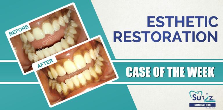 Read more about the article  Esthetic composite restoration