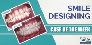 Read more about the article Smile designing