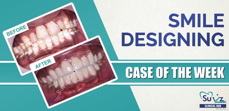 Read more about the article Smile designing