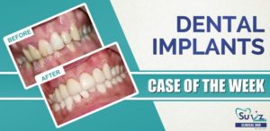 Read more about the article Full mouth rehabilitation
