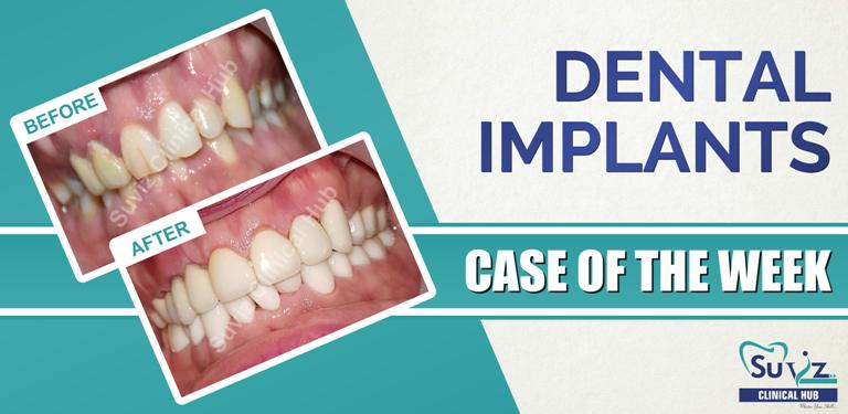 Read more about the article Full mouth rehabilitation