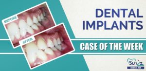 Read more about the article Replacement of a missing tooth using dental implant