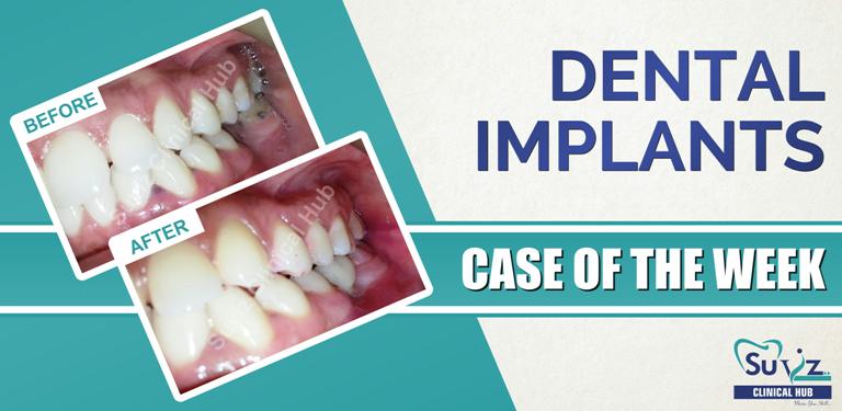 Read more about the article Replacement of a missing tooth using dental implant