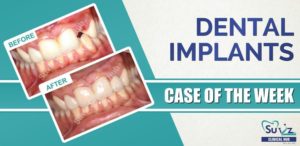 Read more about the article Replacement of a fractured tooth with an immediate implant