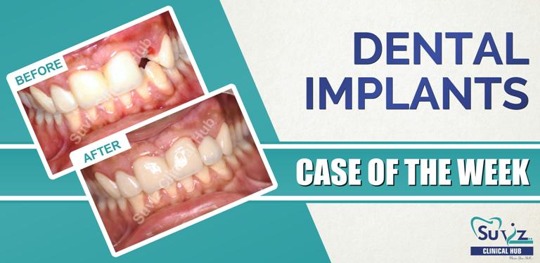 Read more about the article Replacement of a fractured tooth with an immediate implant