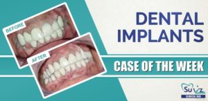 Read more about the article Full Mouth Rehabilitation Using Dental Implants