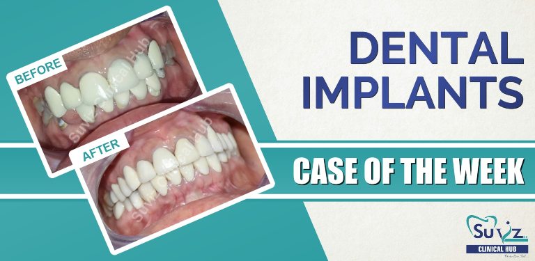 Read more about the article Full Mouth Rehabilitation Using Dental Implants