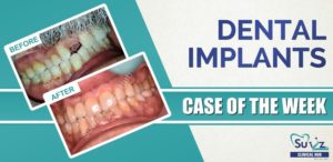 Read more about the article Dental Implants: Implant in the esthetic zone