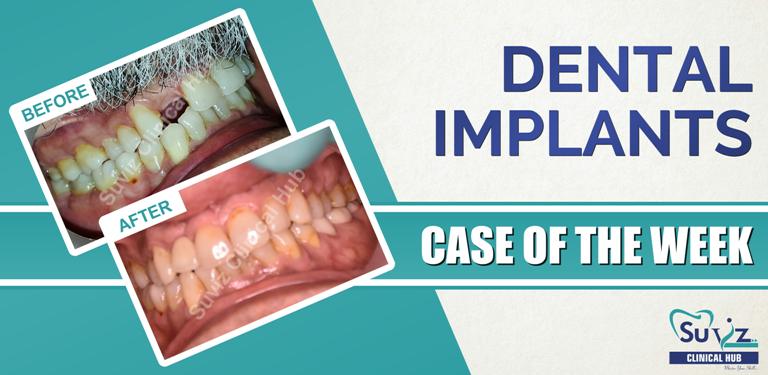Read more about the article Dental Implants: Implant in the esthetic zone