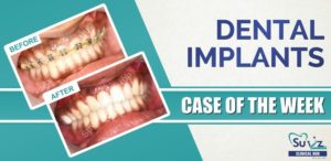 Read more about the article Dental Implant in the esthetic region following autogenous block graft