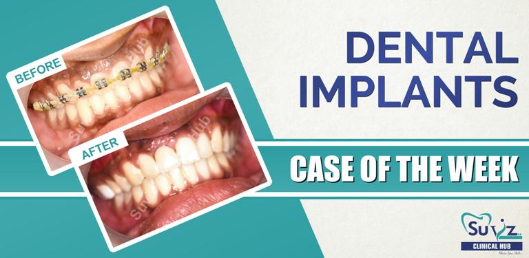 Read more about the article Dental Implant in the esthetic region following autogenous block graft