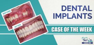 Read more about the article Full mouth rehabilitation using dental implants
