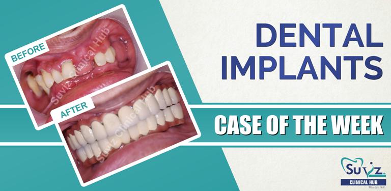 Read more about the article Full mouth rehabilitation using dental implants