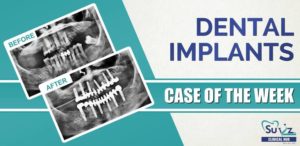 Read more about the article Full mouth implant rehabilitation