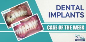 Read more about the article Anterior Single Implant