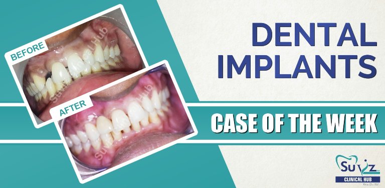 Read more about the article Anterior Single Implant