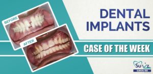 Read more about the article Midline Diastema Correction