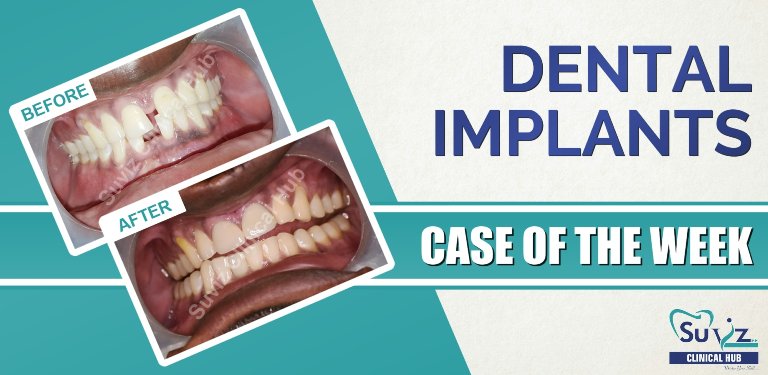 Read more about the article Midline Diastema Correction