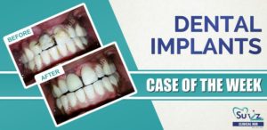 Read more about the article Replacement of the missing anterior tooth using dental implant