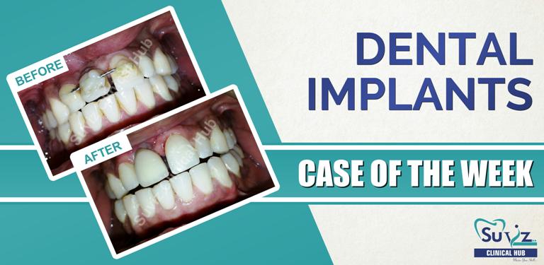Read more about the article Replacement of the missing anterior tooth using dental implant