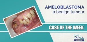 Read more about the article Ameloblastoma a Benign Tumour