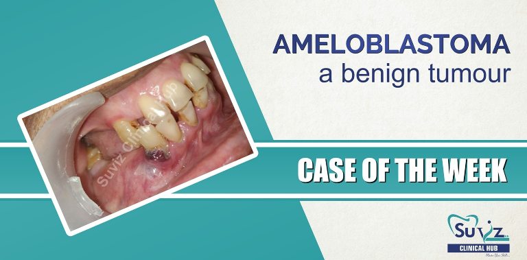 Read more about the article Ameloblastoma a Benign Tumour