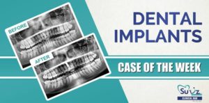Read more about the article Rehabilitation of discolored tooth