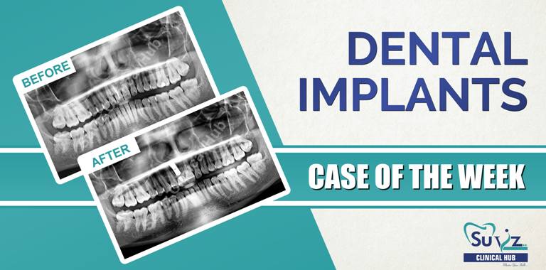 Read more about the article Rehabilitation of discolored tooth
