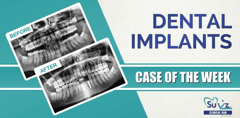 Read more about the article Enucleation of radicular cyst